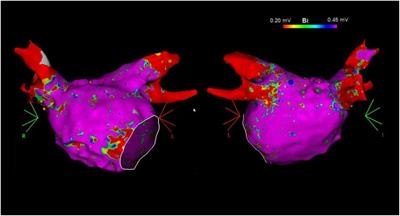 Impact of Left Atrial Bipolar Electrogram Voltage on First Pass Pulmonary Vein Isolation During Radiofrequency Catheter Ablation